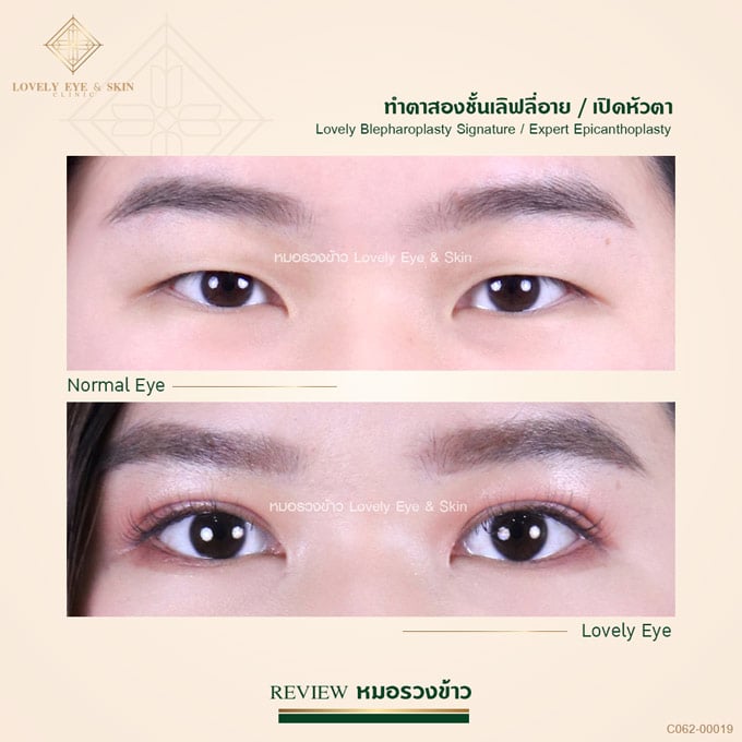 C062-00019-ทำตาสองชั้น เปิดหัว-หมอรวงข้าว.jpg
