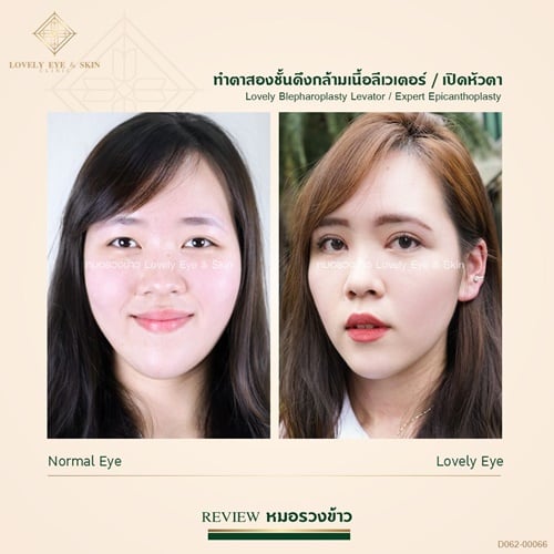 หนังตาตก แก้ไขโดยทำตาสองชั้นแบบดึงกล้ามเนื้อตาลีเวเตอร์