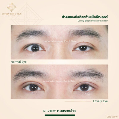 กล้ามเนื้อตาอ่อนแรง 