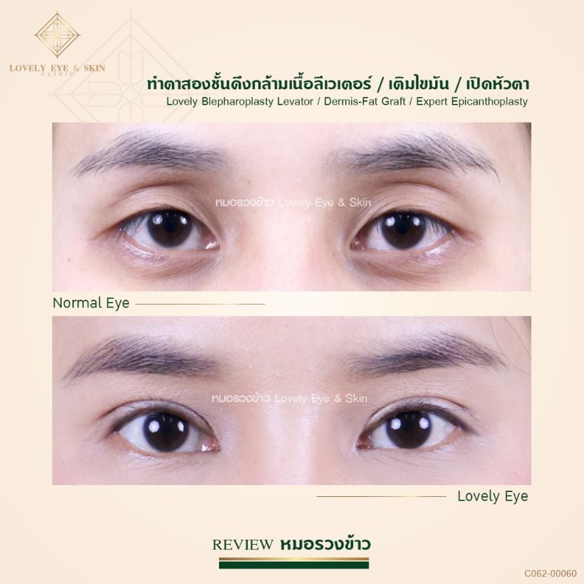 ทำตาสองชั้น ร่วมกับการดึงกล้ามเนื้อตา เติมไขมัน แก้ปัญหา เบ้าตาลึก ชั้นตาสูง