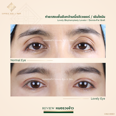 เติมไขมันเบ้าตา แก้ชั้นตาสูง แก้เบ้าตาลึก