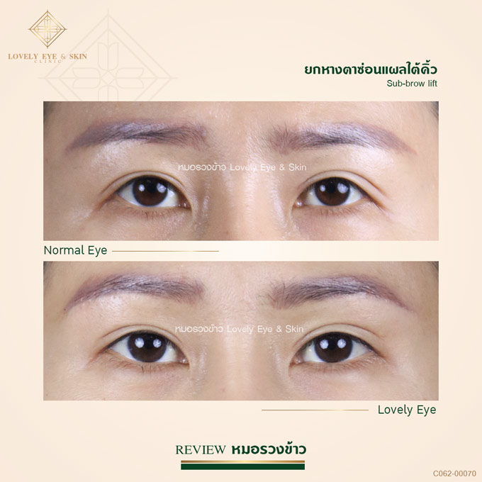 หางตาตกทำไง ยกหางตา ไม่ผ่าตัดทำได้จริงไหม? | Lovely Eye Clinic