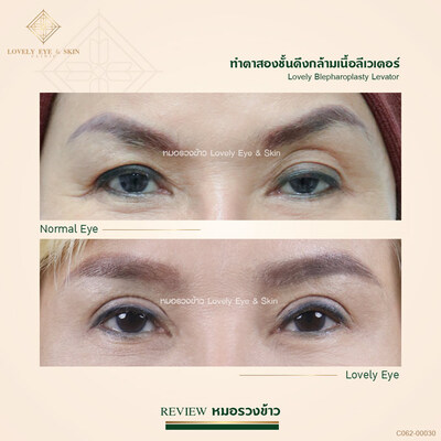 กล้ามเนื้อตาอ่อนแรง 