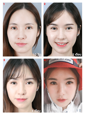 แก้ตาสองชั้น เปิดหัวตา