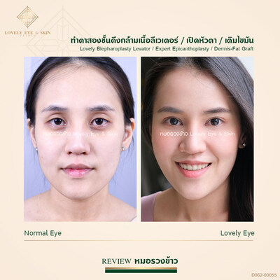 กล้ามเนื้อตาอ่อนแรง 