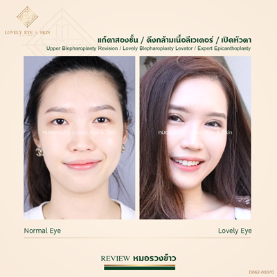 แก้ตาสองชั้น ดึงกล้ามเนื้อตา เปิดหัวตา เทคนิคหมอรวงข้าว