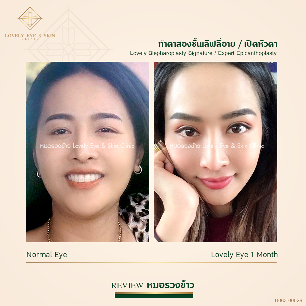D063-00026 ทำตาสองชั้น เปิดหัวตา รีวิวหมอรวงข้าว.png