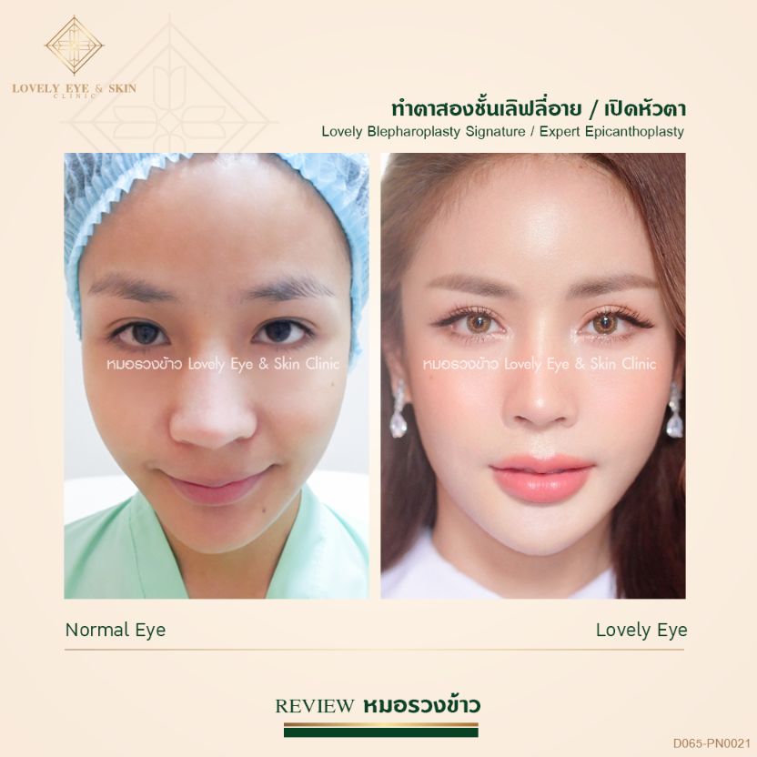 ชั้นตาหลบใน จากหนังตาเกิน มีเนื้อรั้งหัวตา