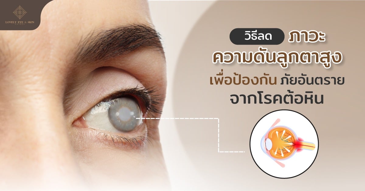 วิธีลดภาวะความดันลูกตาสูง เพื่อป้องกันภัยอันตรายจากโรคต้อหิน
