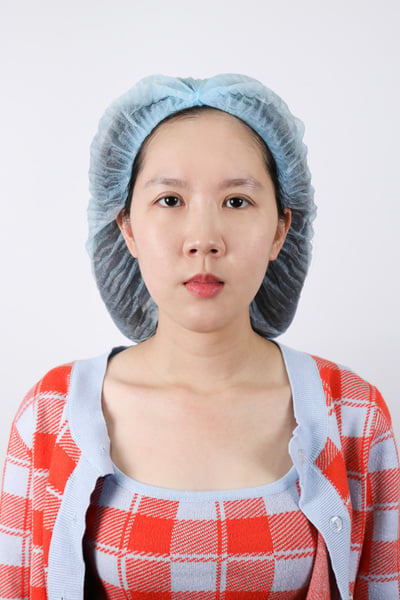 ยกหางตาซ่อนแผลใต้คิ้ว ยกใต้คิ้ว หางตาตก Sub-brow lift