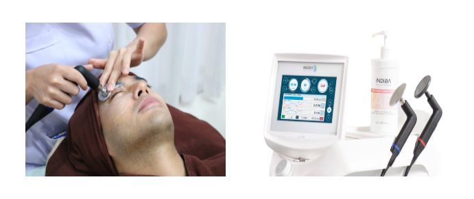 Indiba Eye Restore ลดถุงใต้ตา และริ้วรอยได้ ไม่เจ็บ.jpg