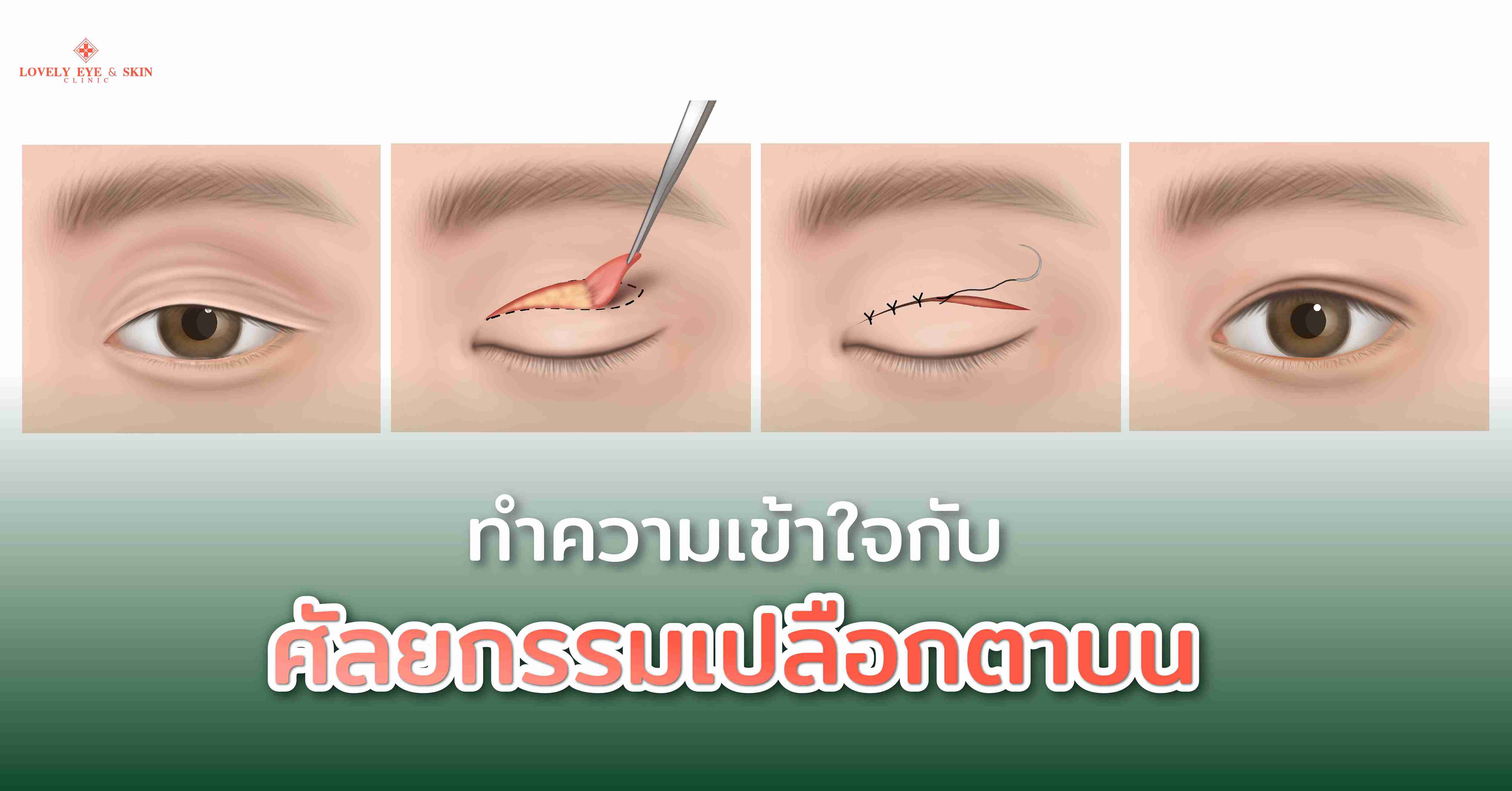 ทำความเข้าใจกับศัลยกรรมเปลือกตาบน