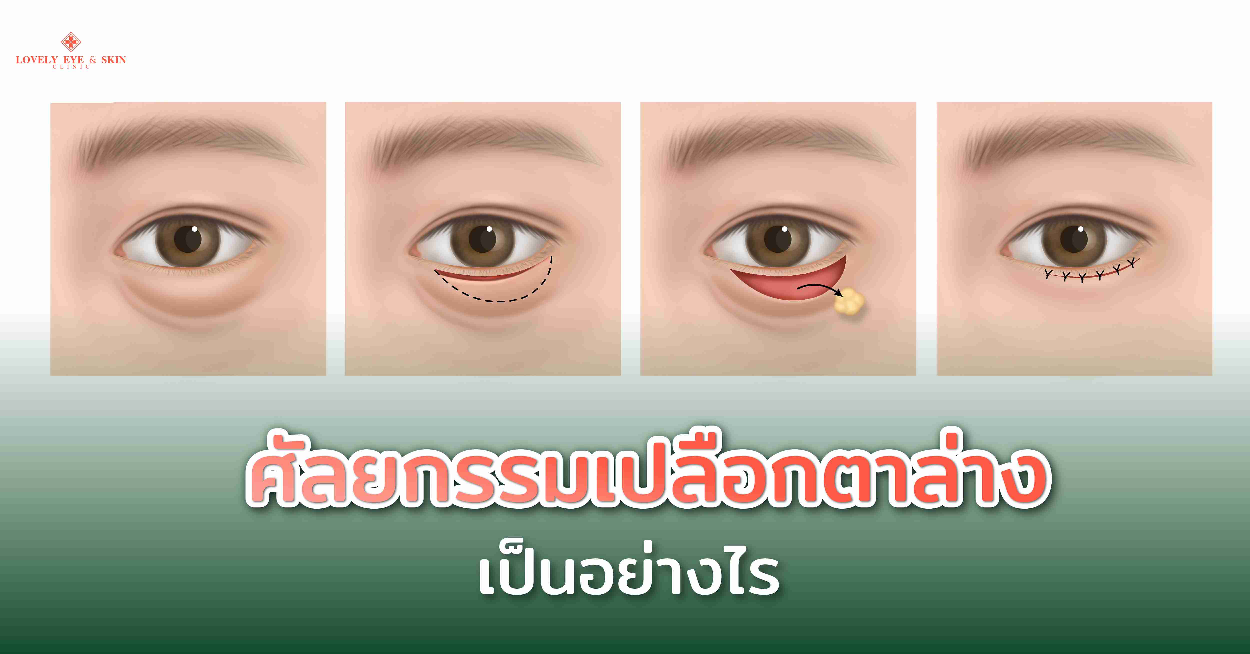 ศัลยกรรมเปลือกตาล่างเป็นอย่างไร