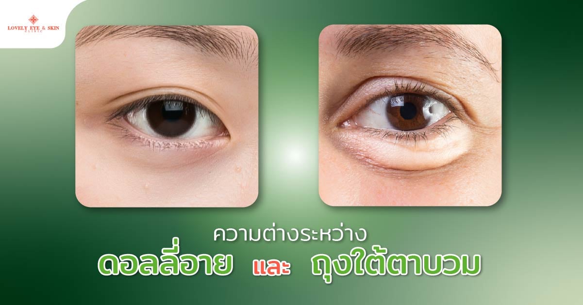 ความต่างระหว่างดอลลี่อายและถุงใต้ตาบวม