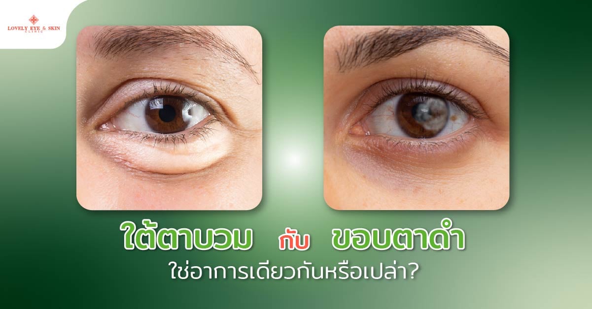 ใต้ตาบวมกับขอบตาดำ ใช่อาการเดียวกันหรือเปล่า?
