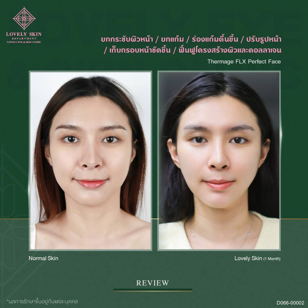 รีวิวทำ Thermage ที่ Lovely Eye Clini