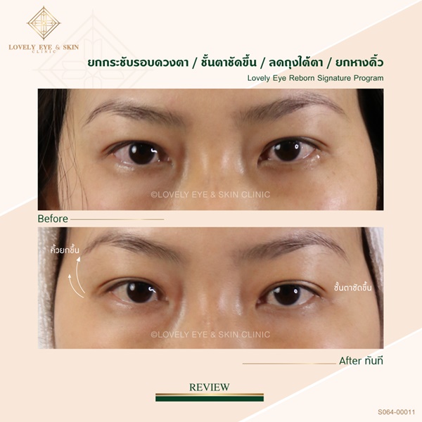 รีวิว thermage eye-Reborn-Signature
