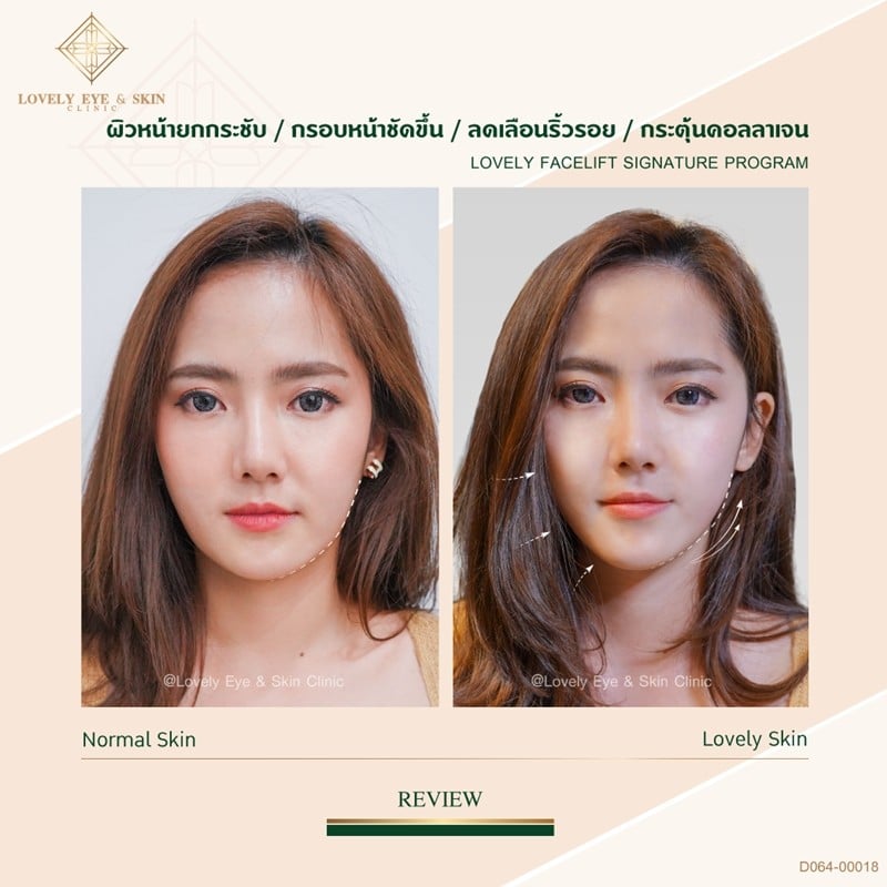 Lovely Facelift Signature Program Review