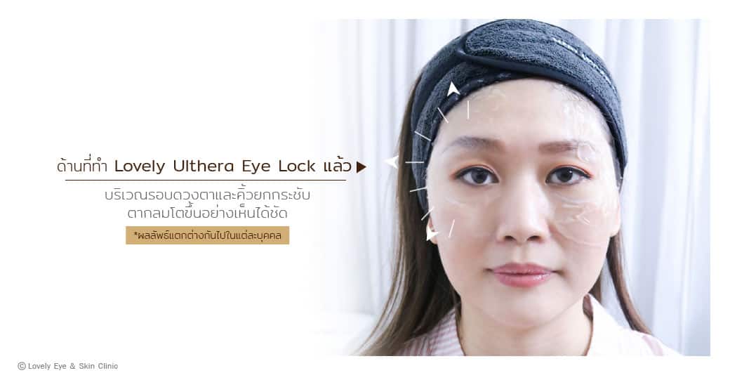 Lovely-Ulthera-eye-lock-ภาพประกอบ-3.jpg