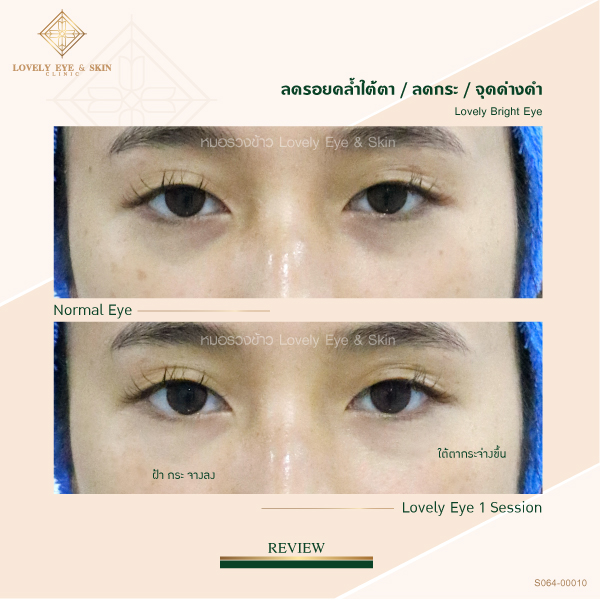 Lovely Bright Eye ลดรอยแดงหลังทำตา ลดรอยคล้ำใต้ตา