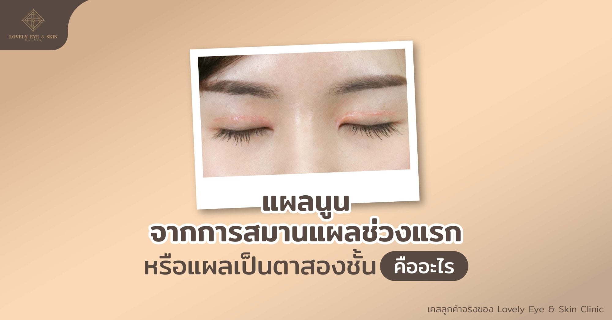แผลนูนจากการทำตาสองชั้น การสมานแผลช่วงแรก มีลักษณะนูน แข็ง สีแดง หรือสีน้ำตาลเข้ม