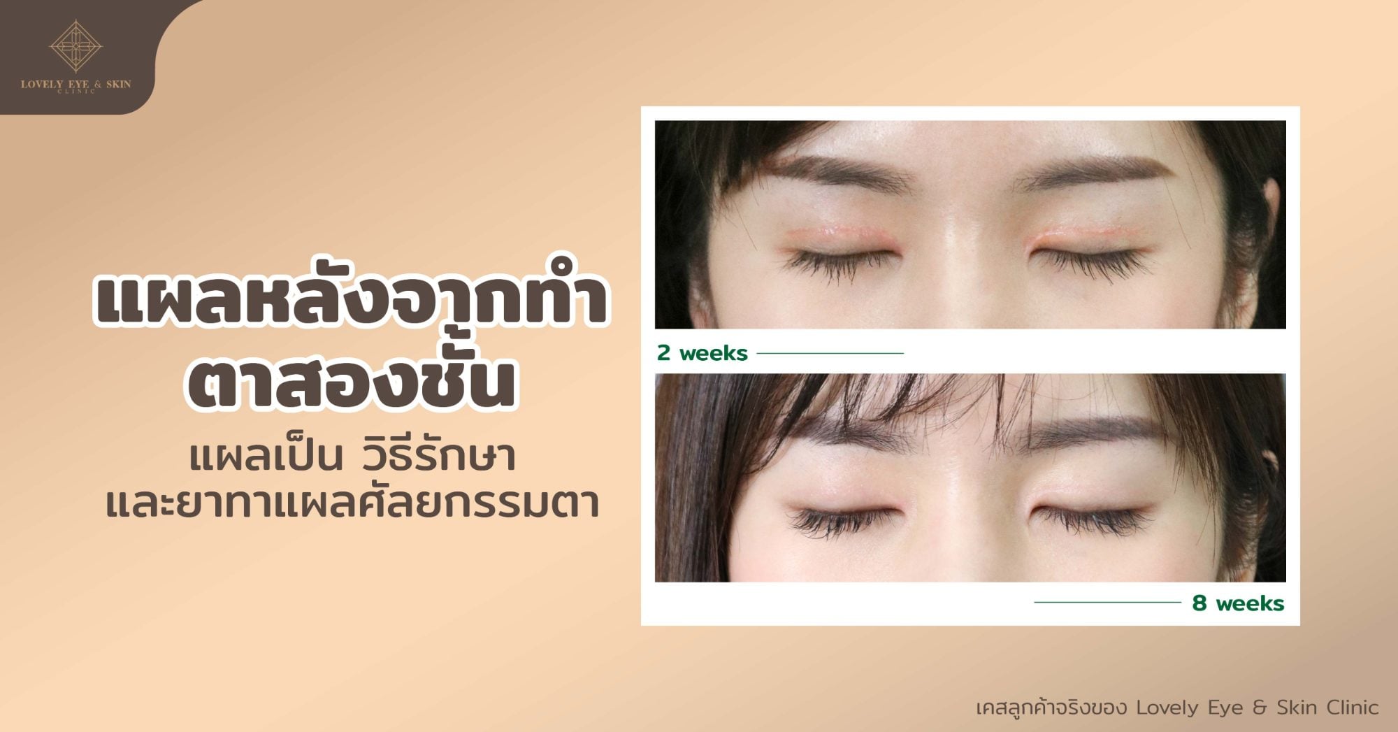 ลักษณะแผลหลังจากทำตาสองชั้น แผลเป็น วิธีรักษา และยาทาแผลหลังศัลยกรรมตา