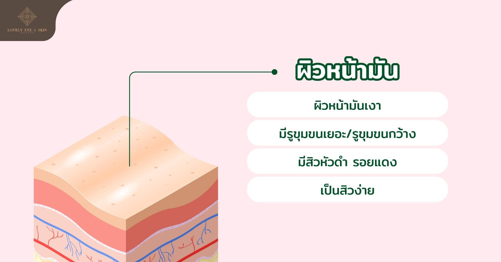 ผิวมัน สังเกตได้จากผิวหน้าจะมีความมันเยิ้ม เกิดสิวง่าย เนื่องจากผิวที่ผลิตน้ำมันมากเกินไป
