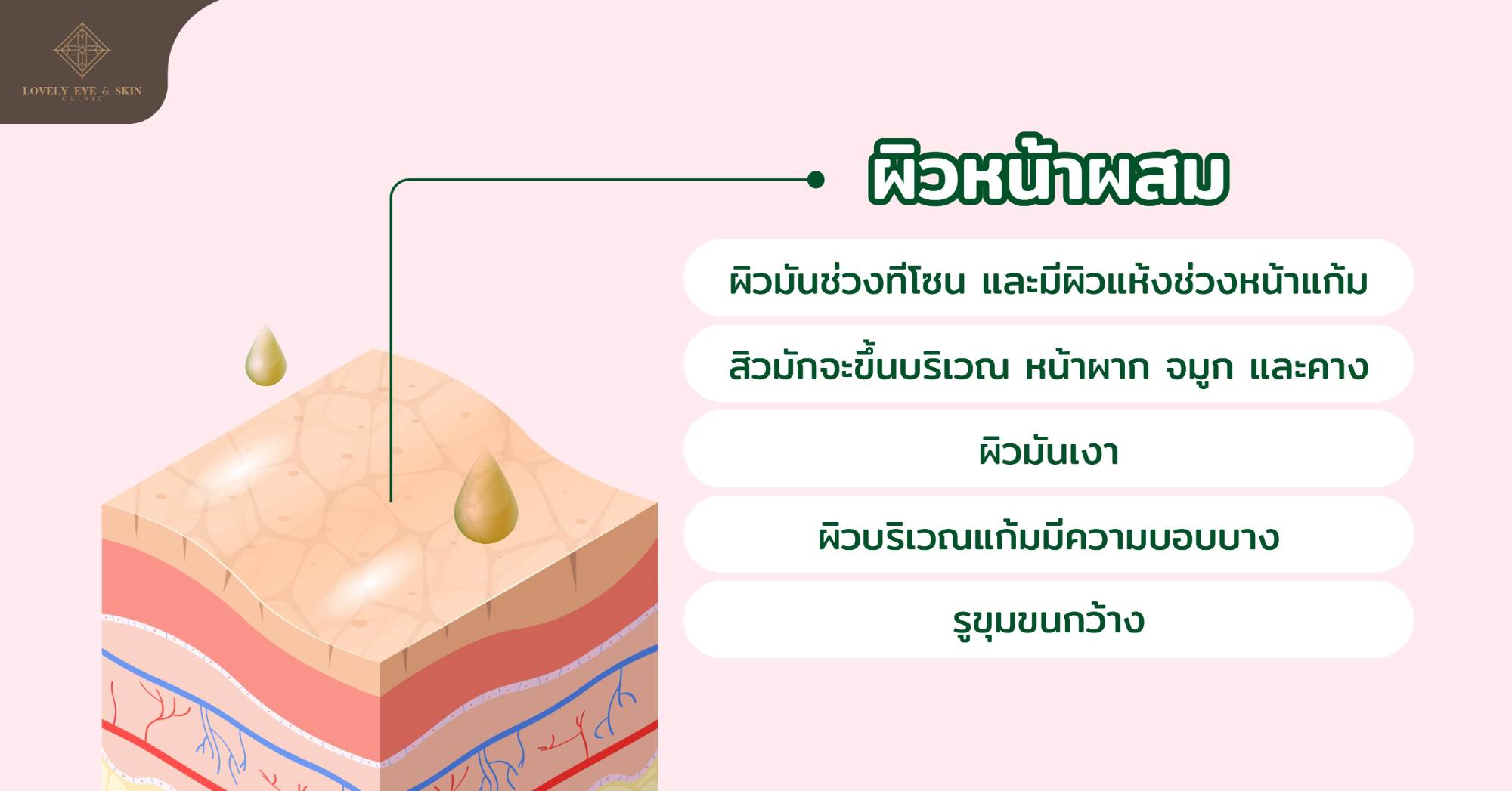 ผิวผสม ซึ่งก็หมายความว่า บางส่วนบนใบหน้านั้นมีความแห้ง ในขณะที่บริเวณอื่นเป็นผิวมัน