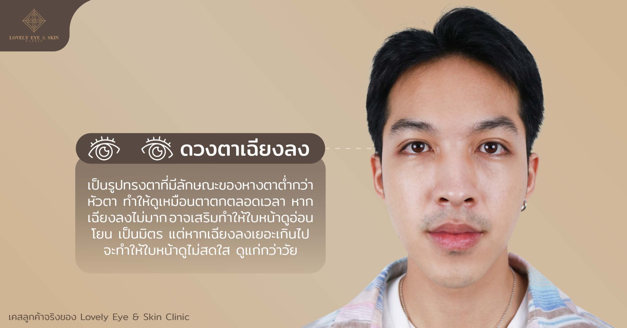 ตาเฉียงลง คือรูปทรงตามีลักษณะของหางตาต่ำกว่าหัวตา ทำให้ตาตก อาจทำให้ใบหน้าดูแก่กว่าวัย 
