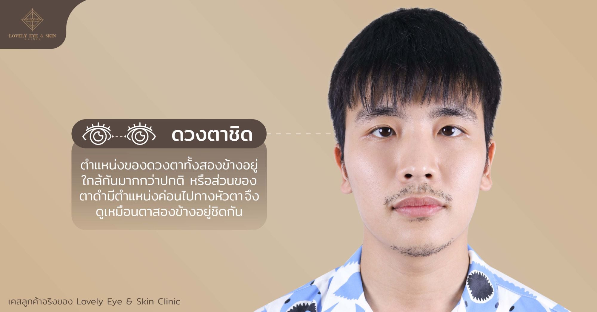 ตาชิด คือตำแหน่งของดวงตาทั้งสองข้างอยู่ใกล้กันมากกว่าปกติ จึงดูเหมือนตาสองข้างอยู่ชิดกัน