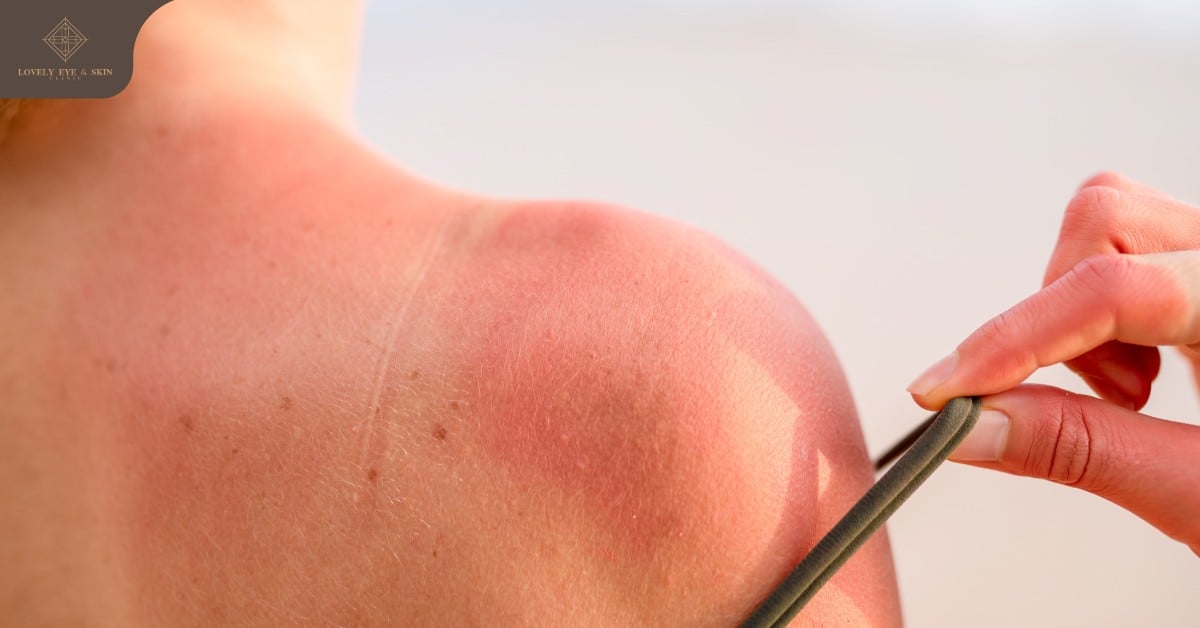 ปัญหาผิวไหม้แดด (sun burn) เกิดจากการตากแดด