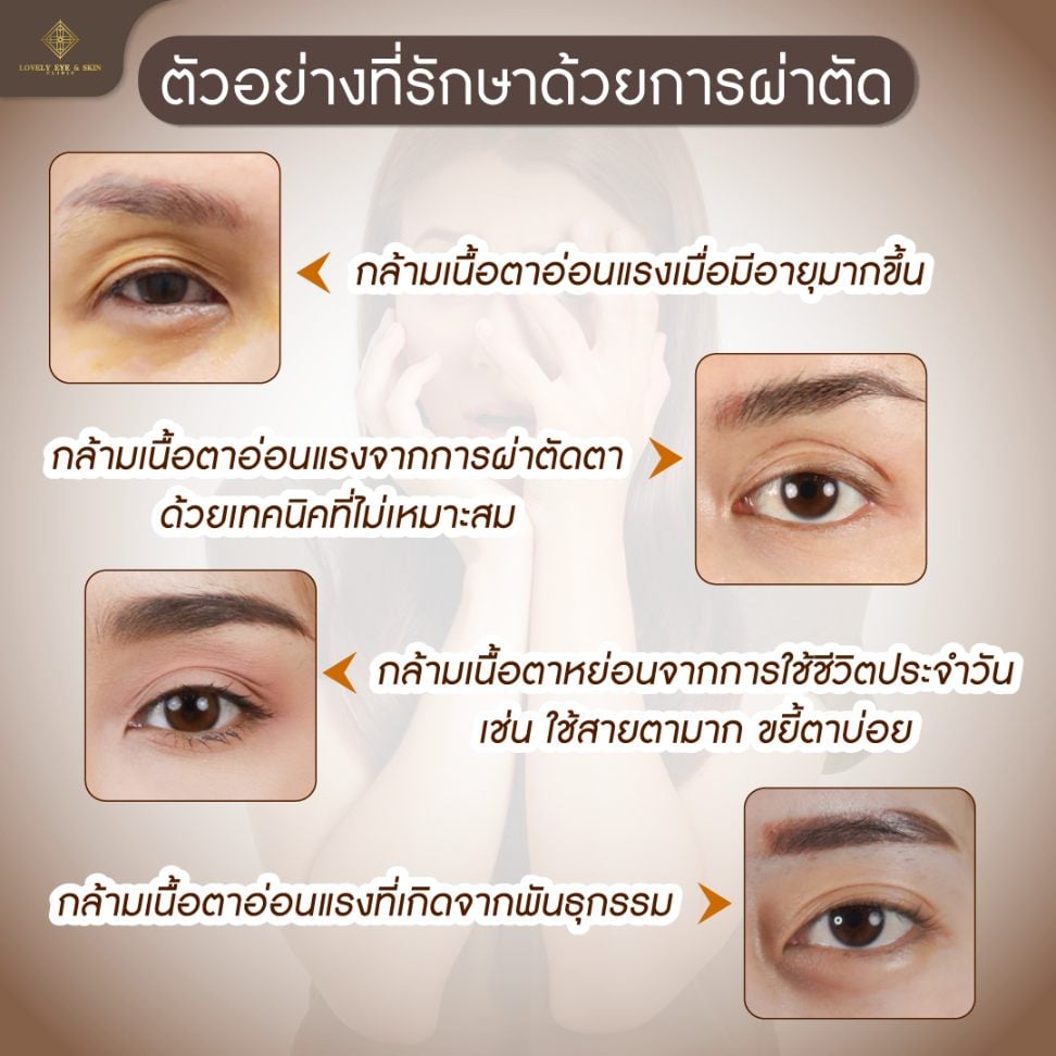 สาเหตุโรคกล้ามเนื้ออ่อนแรง MG กรรมพันธิ์ การหย่อนที่เกิดจากการใช้ชีวิตประจำวัน