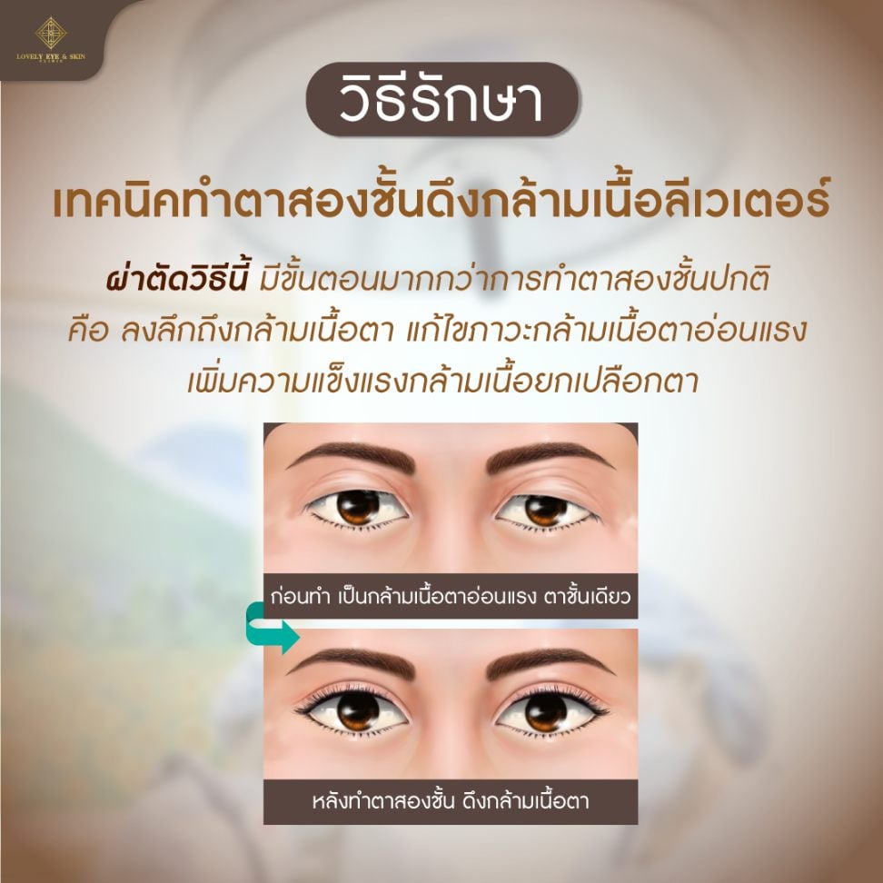 วิธีการรักษาโรค MG โดยการผ่าตัด