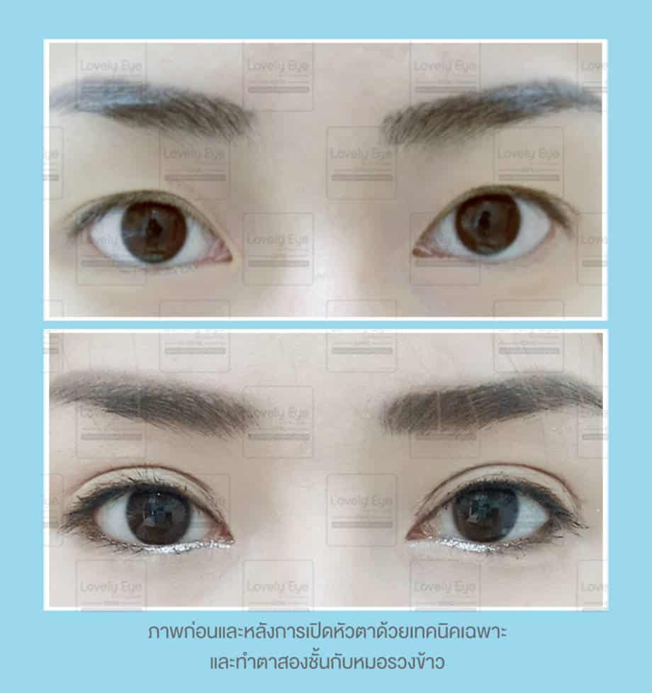 ทำตาสองชั้น เปิดหัวตา