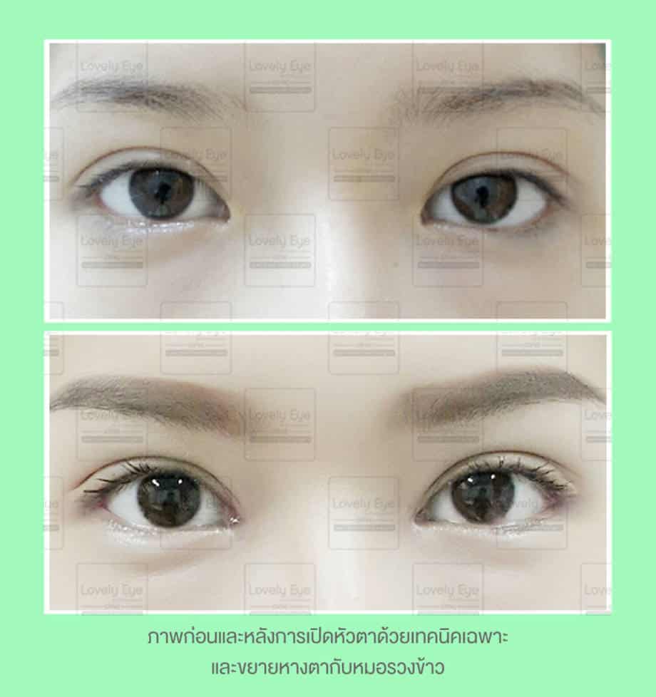 ทำตาสองชั้น เปิดหัวตา