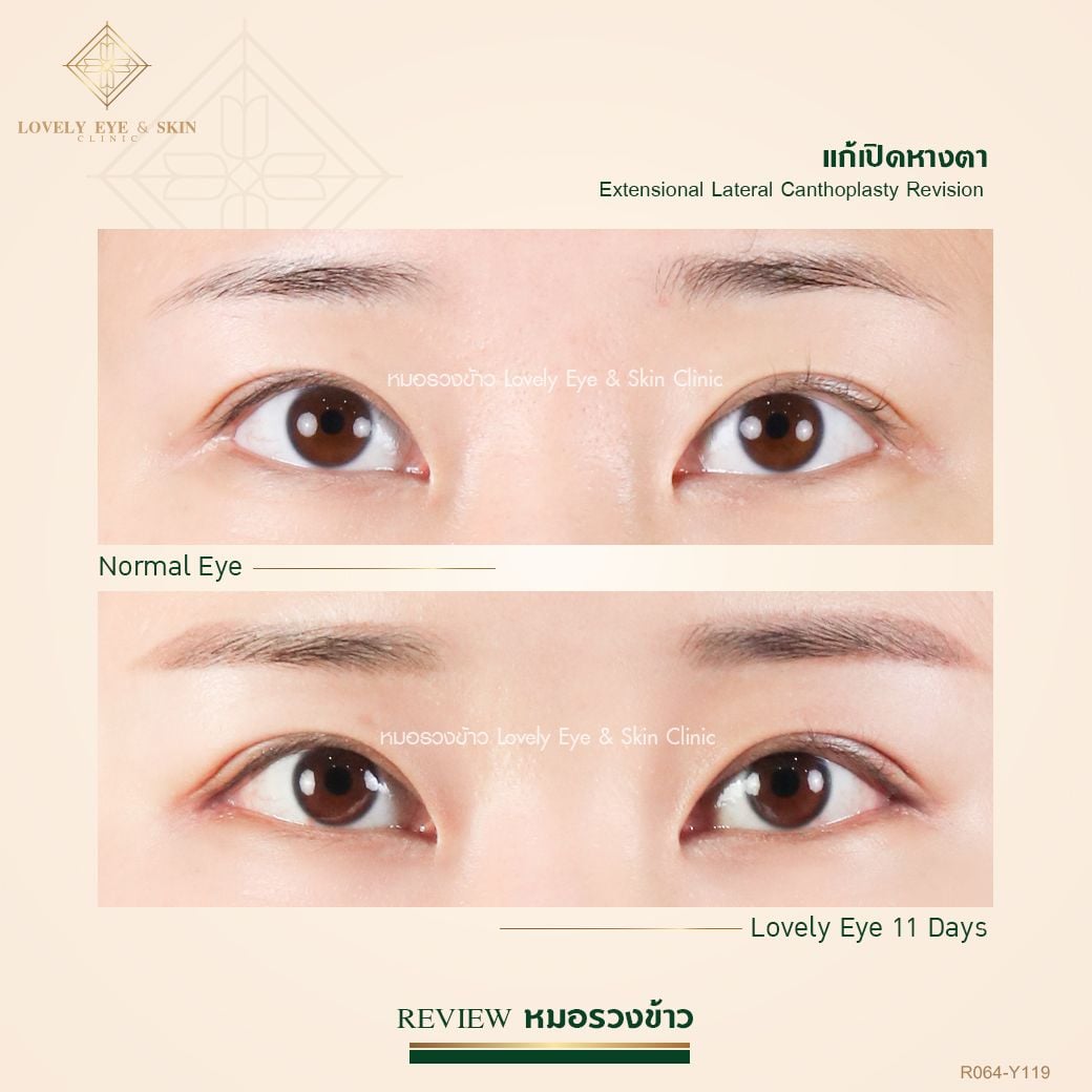 หางตาบาลานซ์กับหัวตา ดวงตาสวยงามได้สัดส่วน 