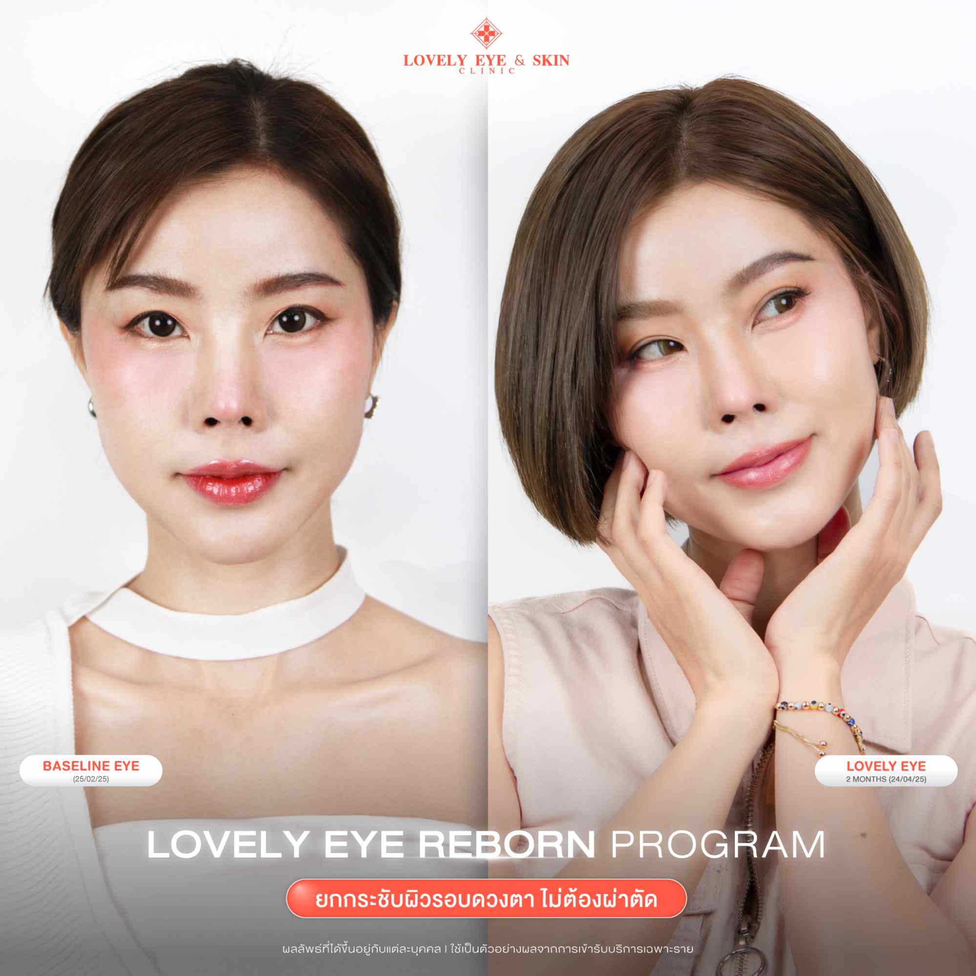 รีวิว Lovely Eye Reborn Program ที่ Lovely Eye & Skin Clinic