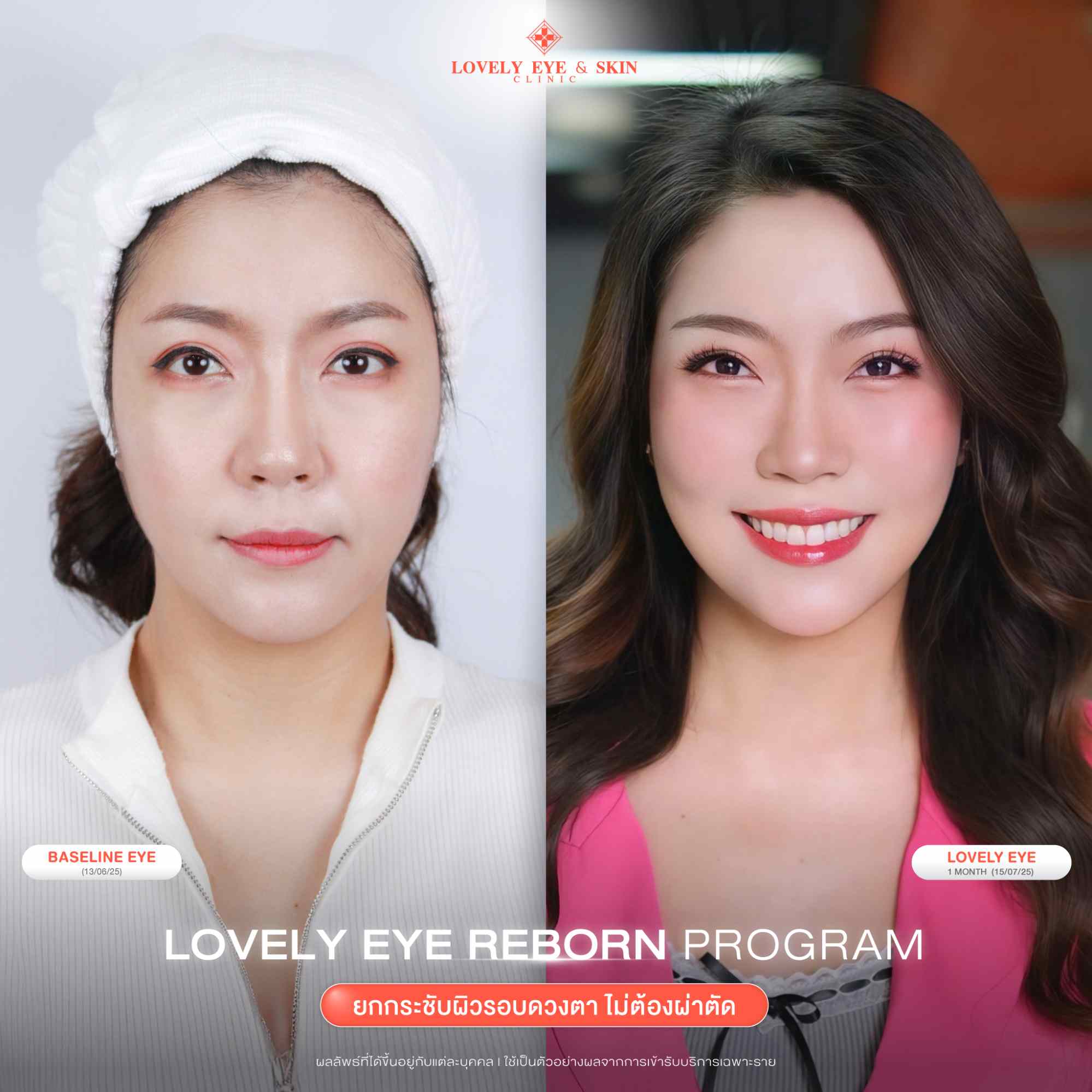 รีวิว Lovely Eye Reborn Program ที่ Lovely Eye & Skin Clinic