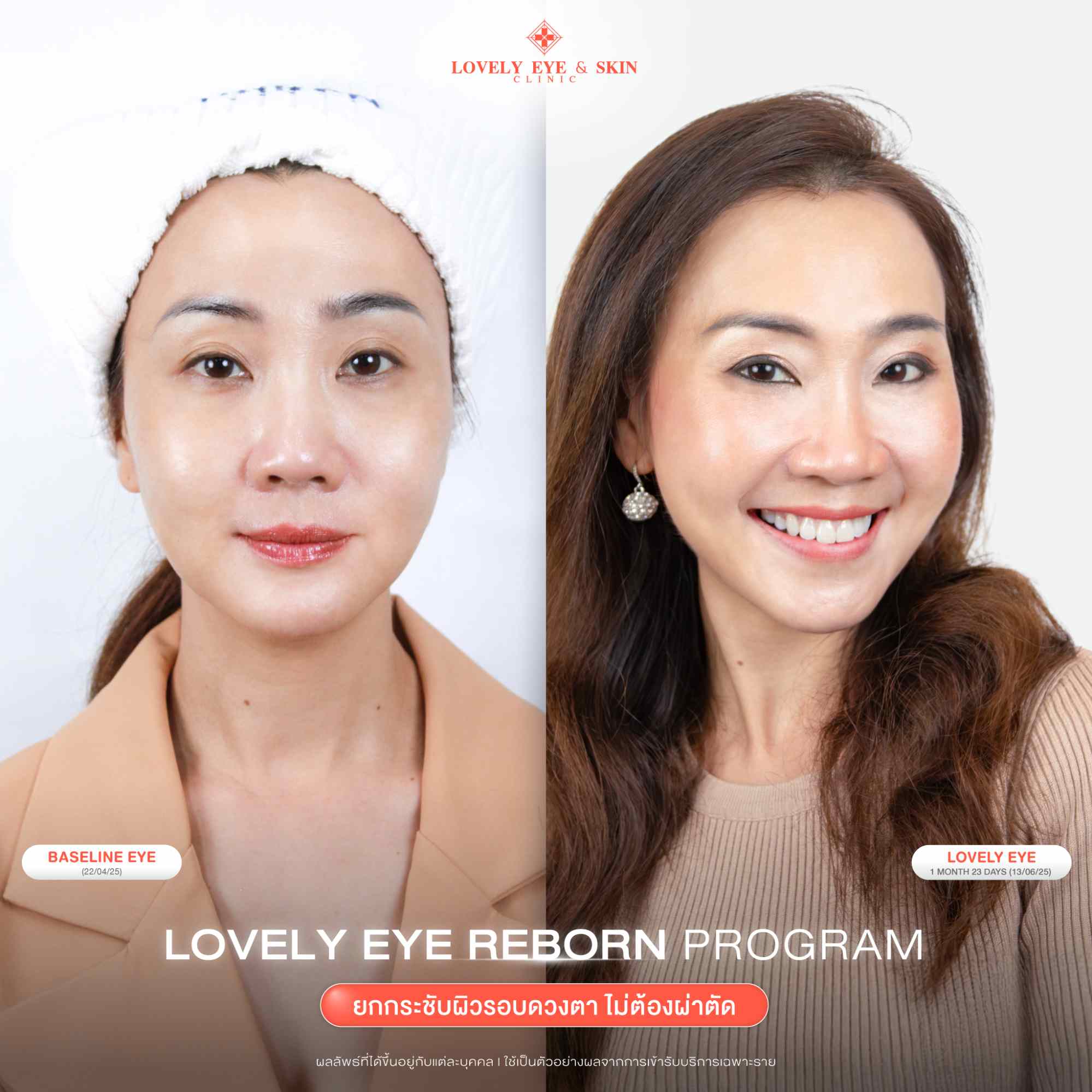 รีวิว Lovely Eye Reborn Program ที่ Lovely Eye & Skin Clinic