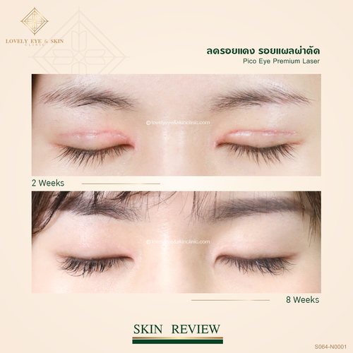 Pico Eye Premium Laser