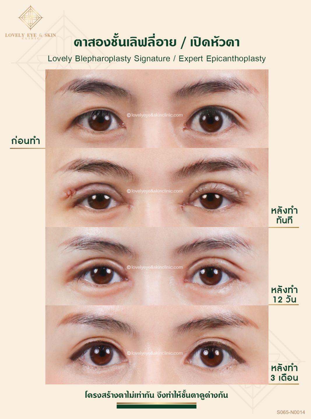 รวม 10 เรื่องที่คนผิดหวังจาการทำตาสองชั้น พร้อมวิธีแก้ | Lovely Eye Clinic