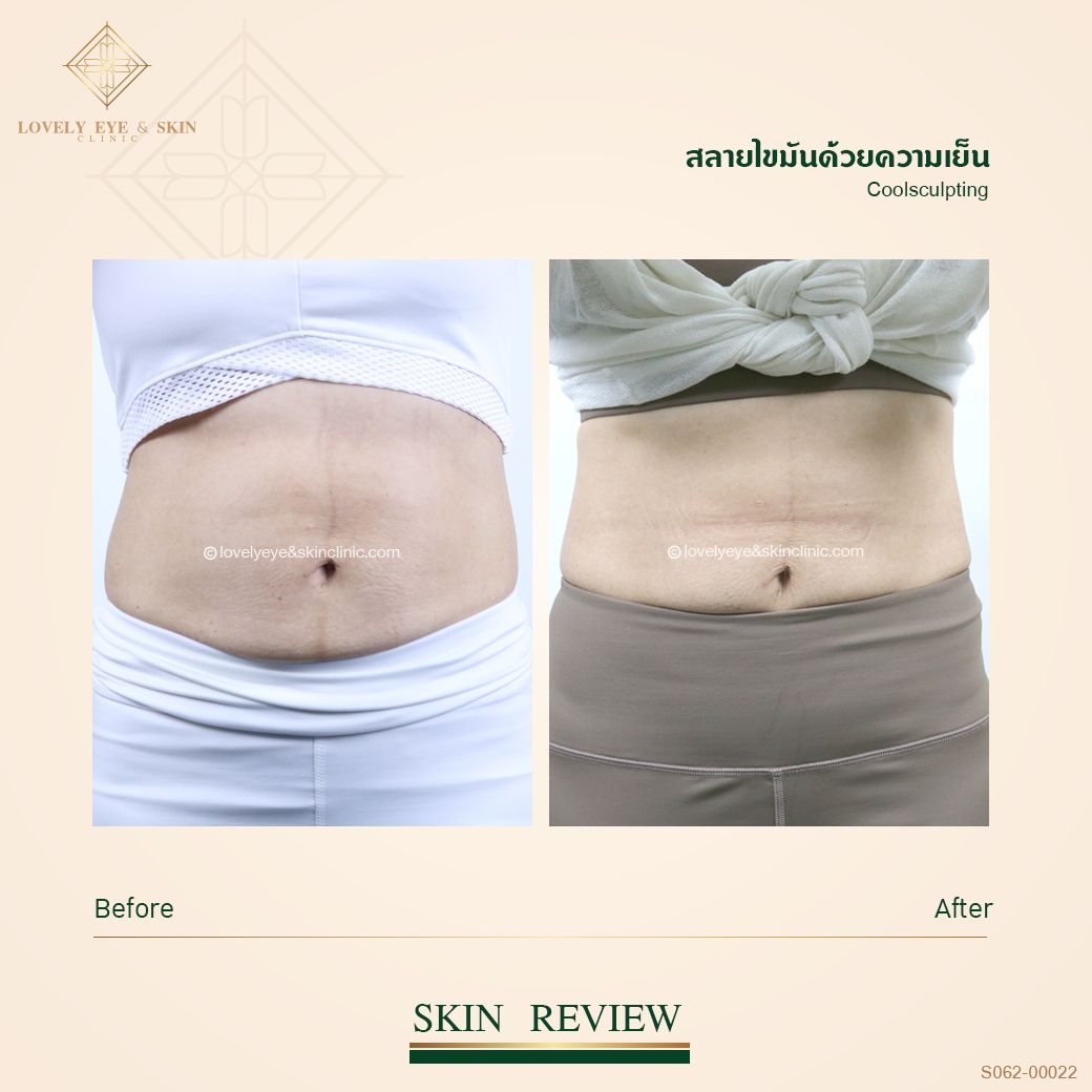 SO62-0022 CoolSculpting หน้าท้อง.jpg