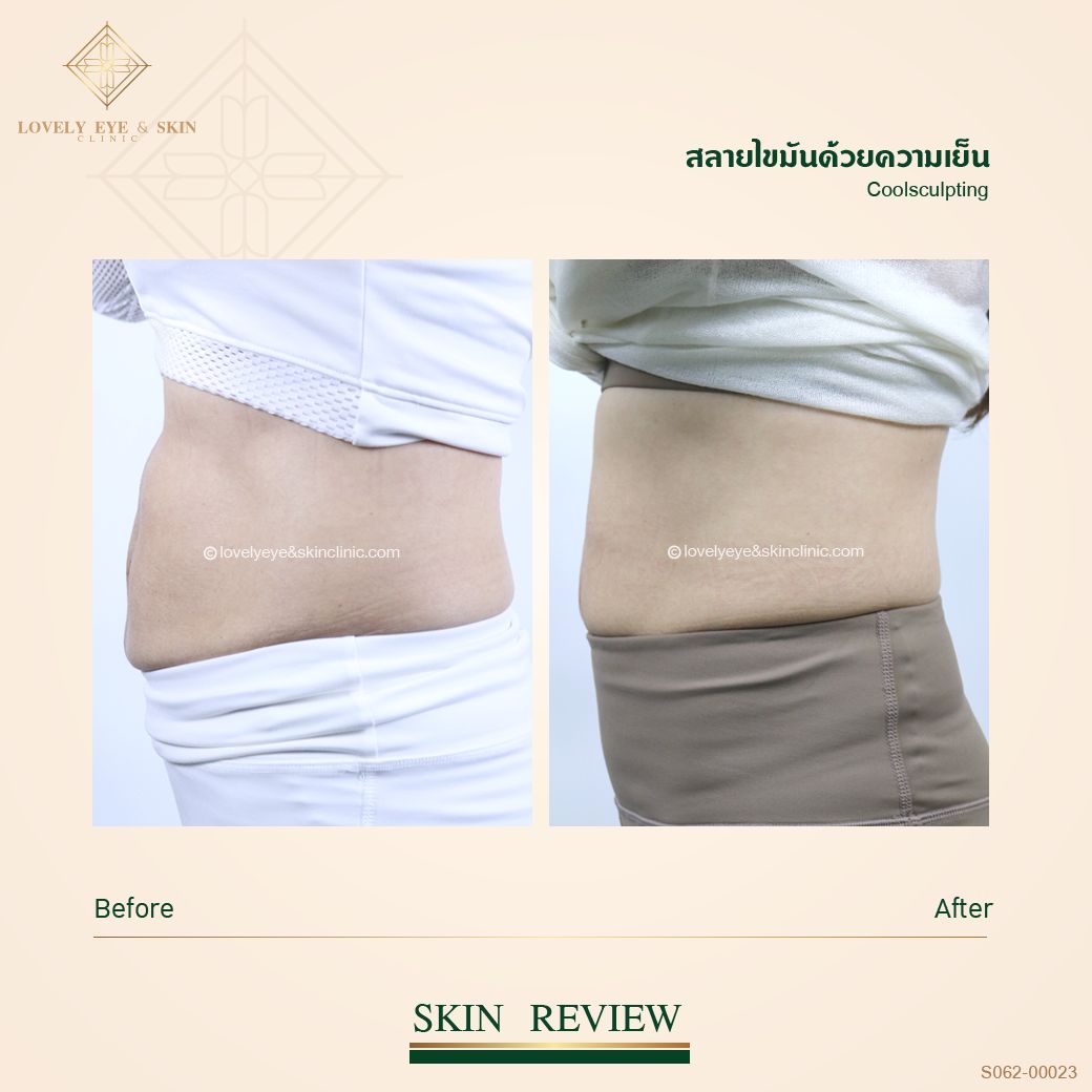 SO62-0023 CoolSculpting หน้าท้อง.jpg