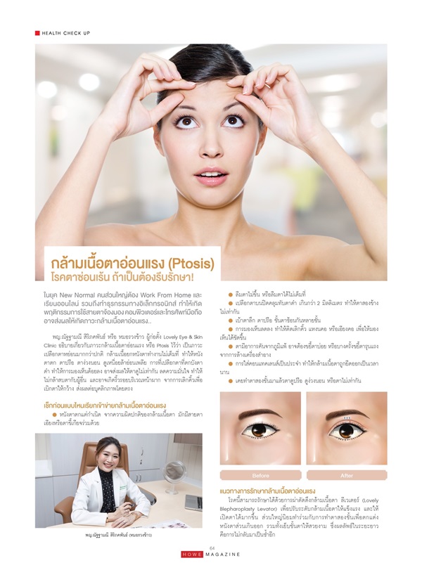 กล้ามเนื้อตาอ่อนแรง (Ptosis) โรคตาซ่อนเร้น