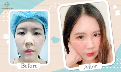 ทำตาสองชั้น ยกใต้คิ้ว