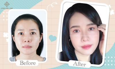 ทำตาสองชั้น ยกใต้คิ้ว