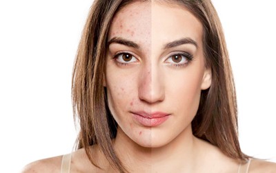 Skincare-Solutions-For-Teen-and-Adult-Hormonal-Acne-Springfield-MO.jpg