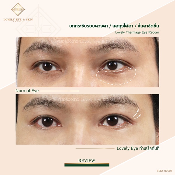 Thermage Eye Reborn (1).jpg