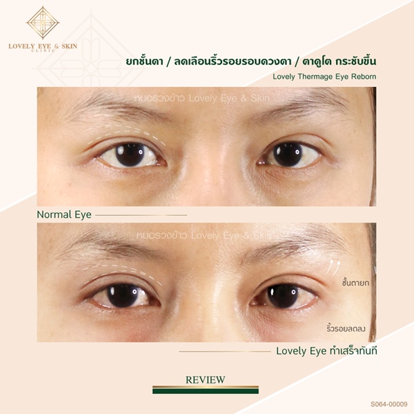 Thermage Eye Reborn (4).jpg