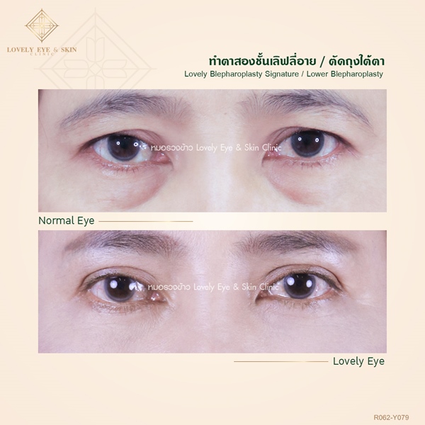 Thermage Eye Reborn (6).jpg